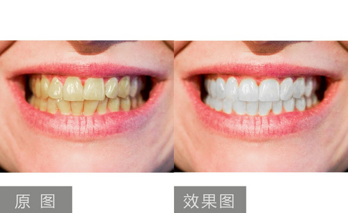 PS-牙齿矫正和美白