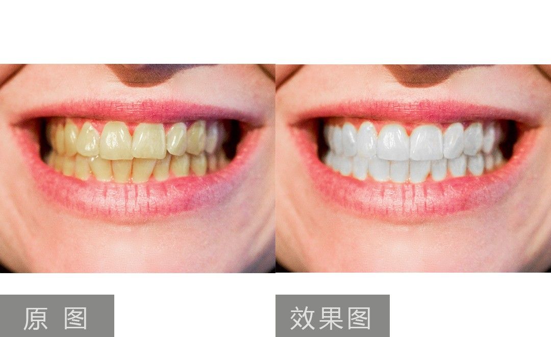 PS-牙齿矫正和美白