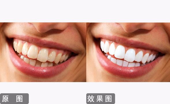 PS-美白与矫正 牙齿精修的第一关